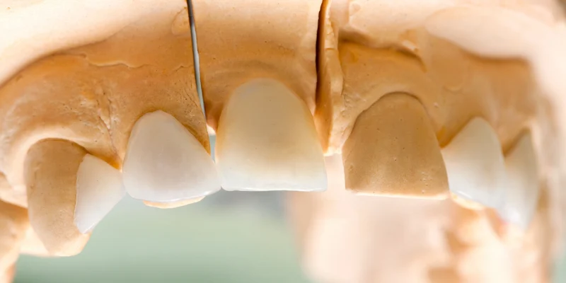 Comparing Dental Implants, Bridges, and Dentures
