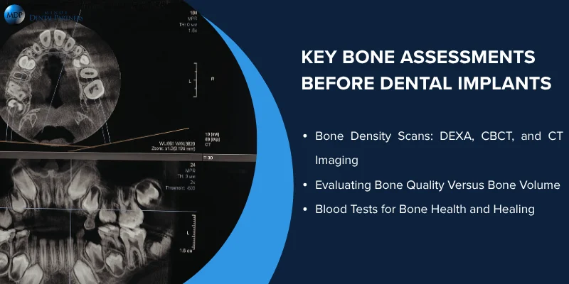 Essential Bone Tests Before Dental Implant Placement