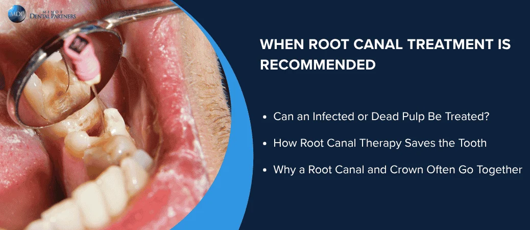 When Root Canal Treatment Is Usually the Better Choice