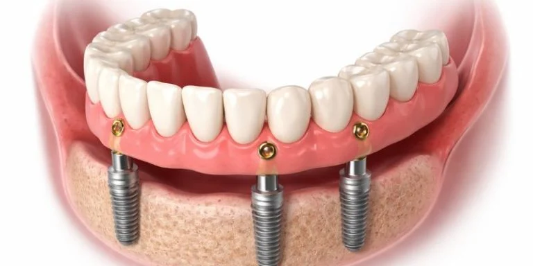 all-on-x dental implants recovery timeline