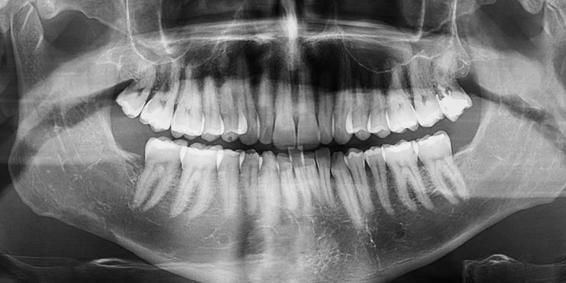 bone density requirements for dental implants