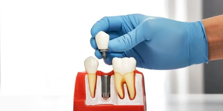 dental implant trends in north dakota