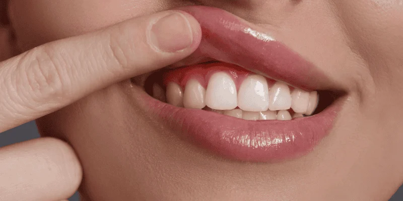 dental implants after periodontal disease