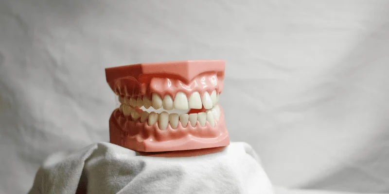 full arch dental implant failure causes