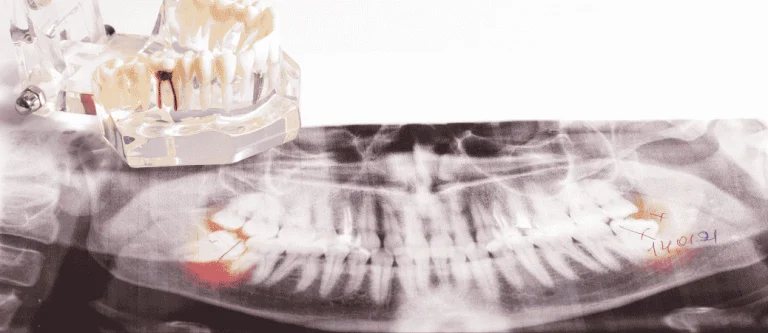 impacted vs erupted wisdom teeth