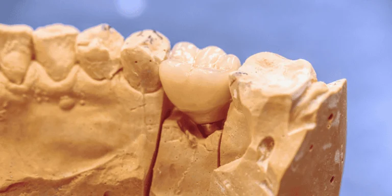 osteoporosis dental implant eligibility