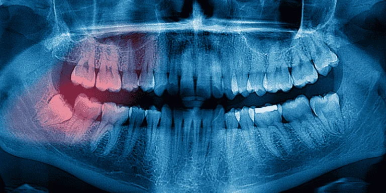 signs you need bone grafting before implants