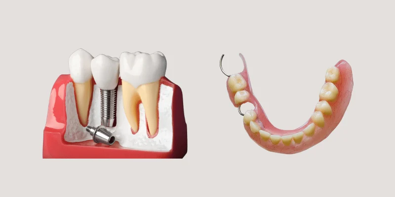 single tooth implant vs partial denture cost