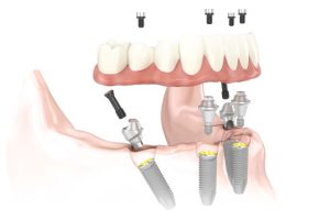 Illustration: All-on-4 demo image for the lower jaw