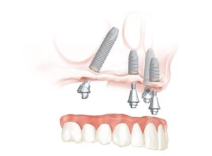 Illustration: All-on-4 demo image for upper jaw