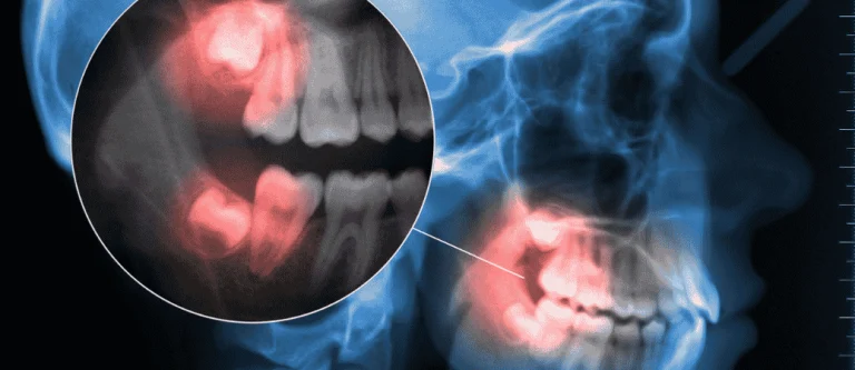 wisdom teeth removal reasons